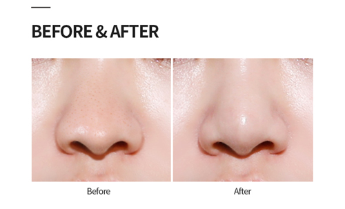 before after bsa blackhead product