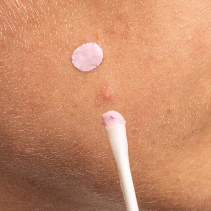 goodbye blemish pink spot 1 - Sonar | Korean Skincare